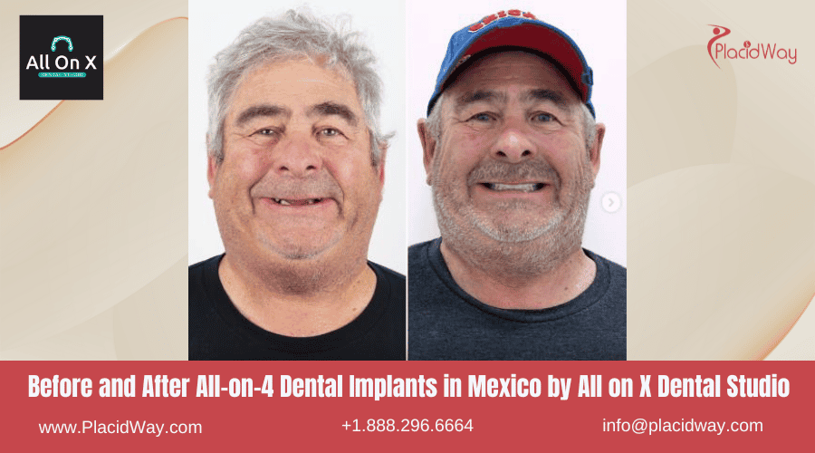 All on 4 Dental Implants in Mexico Before and After Image by All on X Dental Clinic
