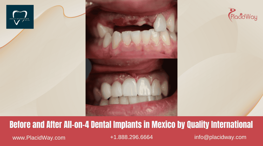 All on 4 Dental Implants in Mexico Before and After Image by QIDC