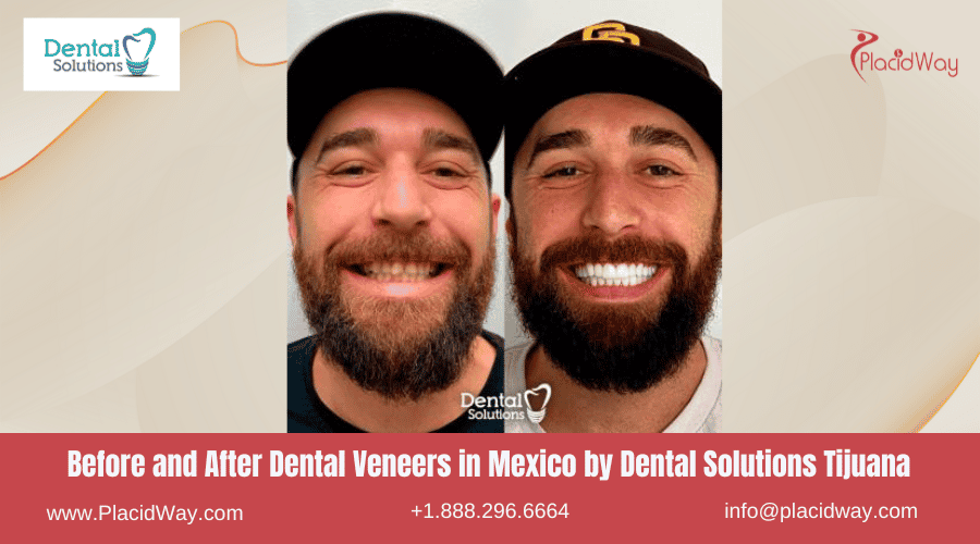 Dental Veneers in Mexico Before and After Image by Dental Solutions