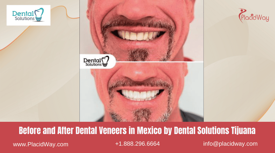 Dental Veneers in Mexico Before and After Image by Dental Solutions Center