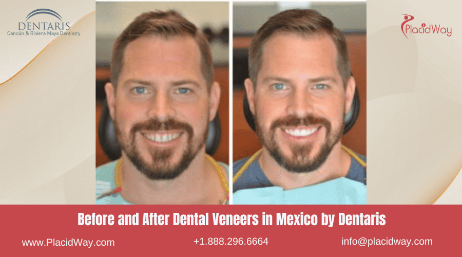 Dental Veneers in Mexico Before and After Image by Dentaris