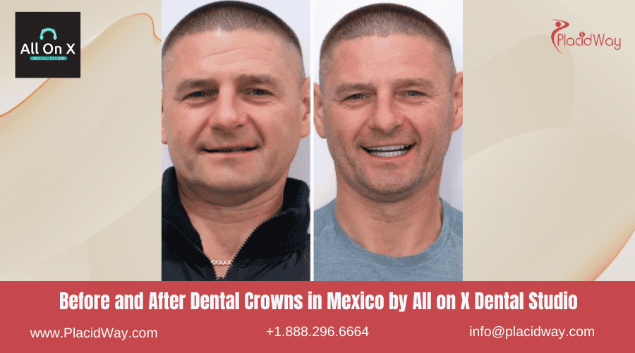 Dental Crowns in Mexico Before and After Image by All on X Dental Studio