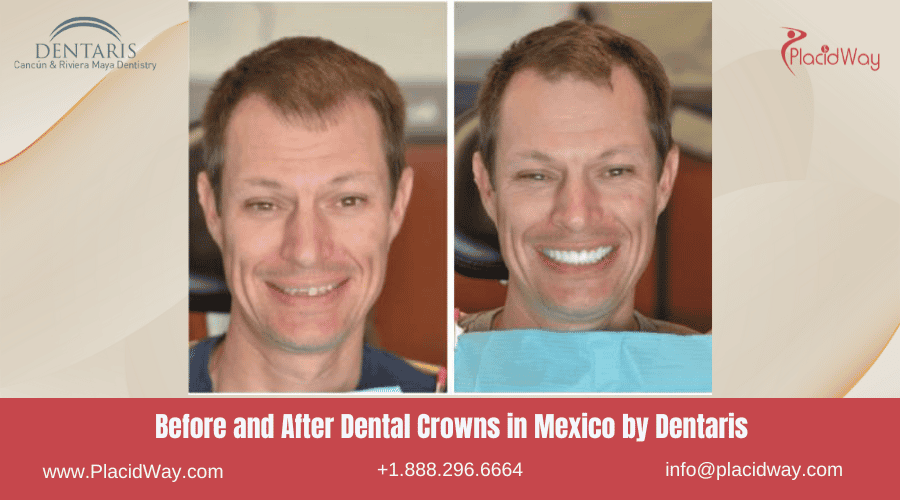 Dental Crowns in Mexico Before and After Image by Dentaris