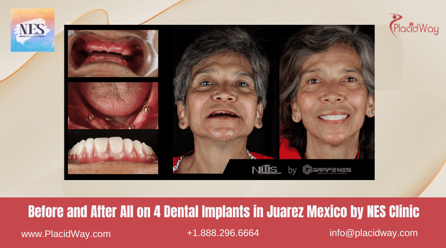 Antes y Después de Implantes Dentales All on 4 en Juárez México por Clínica NES