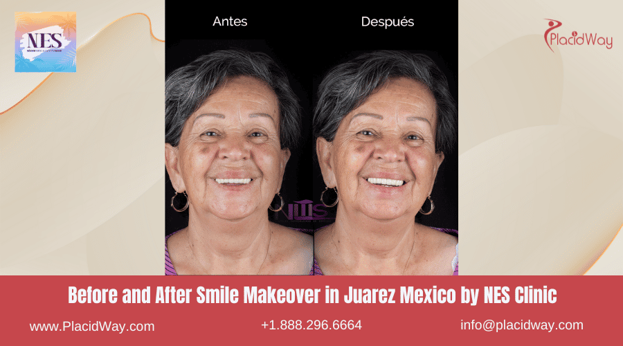 Antes y después de un cambio de imagen de sonrisa en Juárez, México, por la Clínica NES