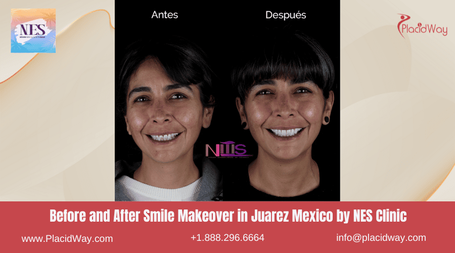 Cambio de Sonrisa Antes y Después en Juárez México por NES Dental Clinic