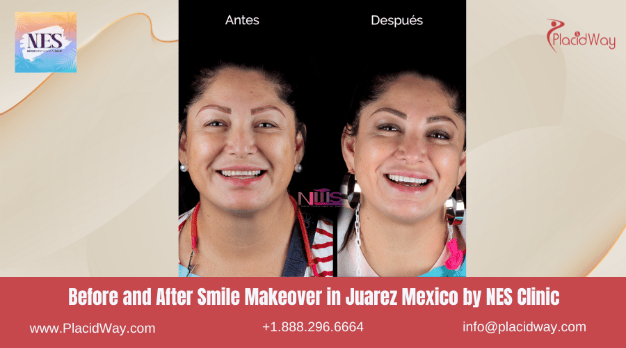 Imagen de antes y después de un cambio de imagen de sonrisa en Juárez, México, por la Clínica NES