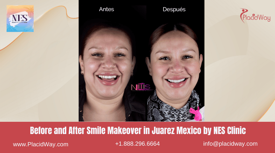Cambio de Imagen de Sonrisa en Juárez México por NES Clinic Imagen de Antes y Después