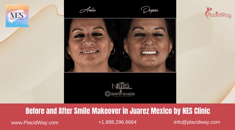 Cambio de imagen de sonrisa en Juárez, México por la Clínica NES Fotografía de antes y después