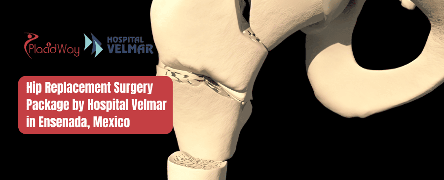 Paquete de cirugía de reemplazo de cadera del Hospital Velmar en Ensenada, México