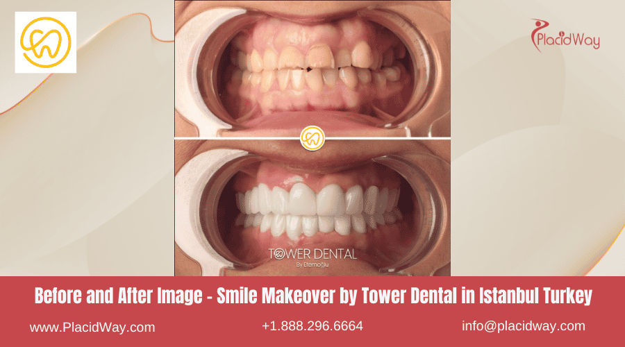 Imagen de antes y después: Renovación de sonrisa de Tower Dental en Estambul, Turquía