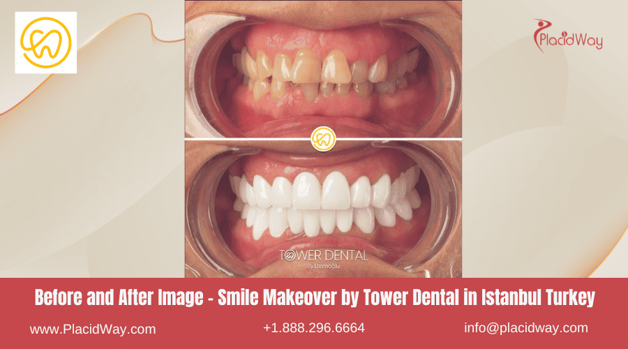 Antes y después de un cambio de imagen de sonrisa realizado por Tower Dental en Estambul, Turquía