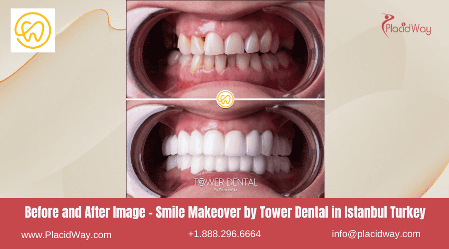 Imagen de antes y después: Renovación de sonrisa de Tower Dental en Estambul, Turquía