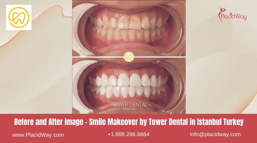 Imagen de antes y después de un cambio de imagen de sonrisa en Estambul, Turquía, realizado por Tower Dental