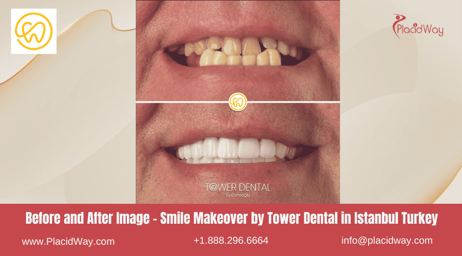 Fotografías de antes y después de un cambio de imagen de sonrisa realizado por Tower Dental en Estambul, Turquía