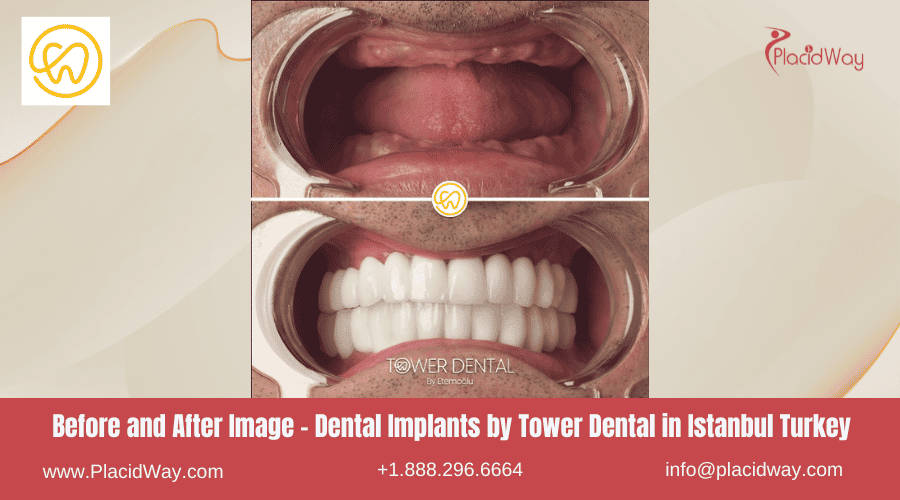 Imagen de antes y después: implantes dentales de Tower Dental en Estambul, Turquía