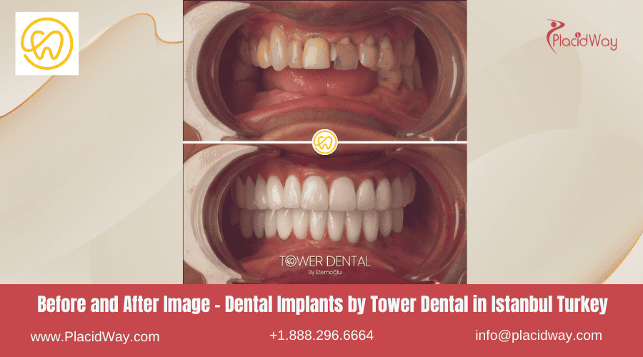 Antes y después de los implantes dentales de Tower Dental en Estambul, Turquía