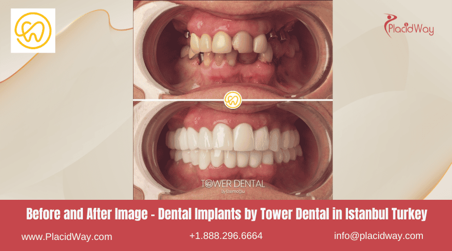 Imágenes de antes y después de implantes dentales en Estambul, Turquía, por Tower Dental