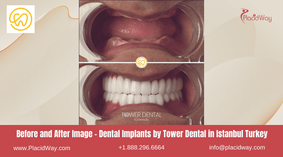 Imágenes de antes y después de implantes dentales en Estambul, Turquía, por Tower Dental Clinic
