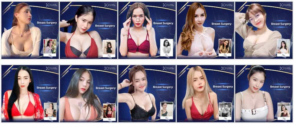 قبل وبعد مستشفى آسيا للتجميل - جراحة الثدي