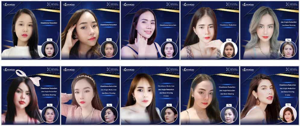 قبل وبعد مستشفى آسيا للتجميل - تصغير عظمة الخد