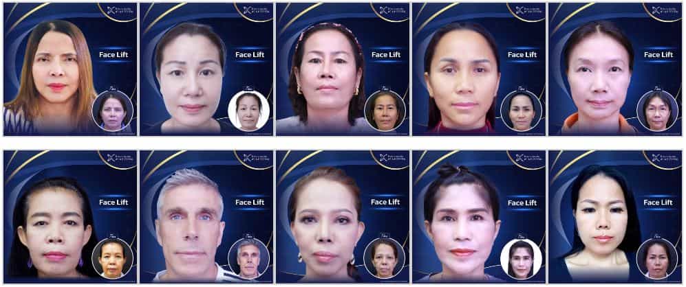 قبل وبعد مستشفى آسيا للتجميل - شد الوجه