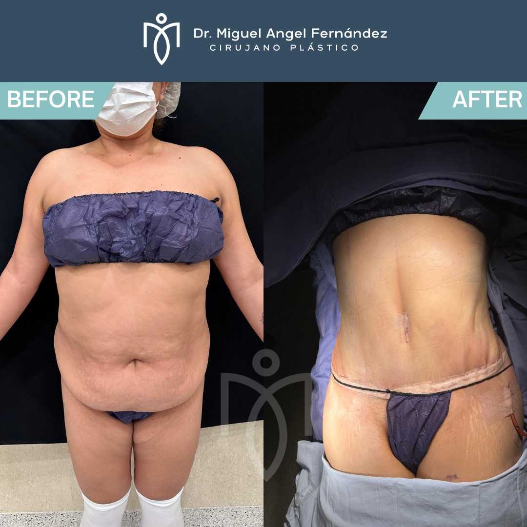 Antes y Despues - Dr. Miguel Angel Fernandez - Abdominoplastia en Mexicali Mexico
