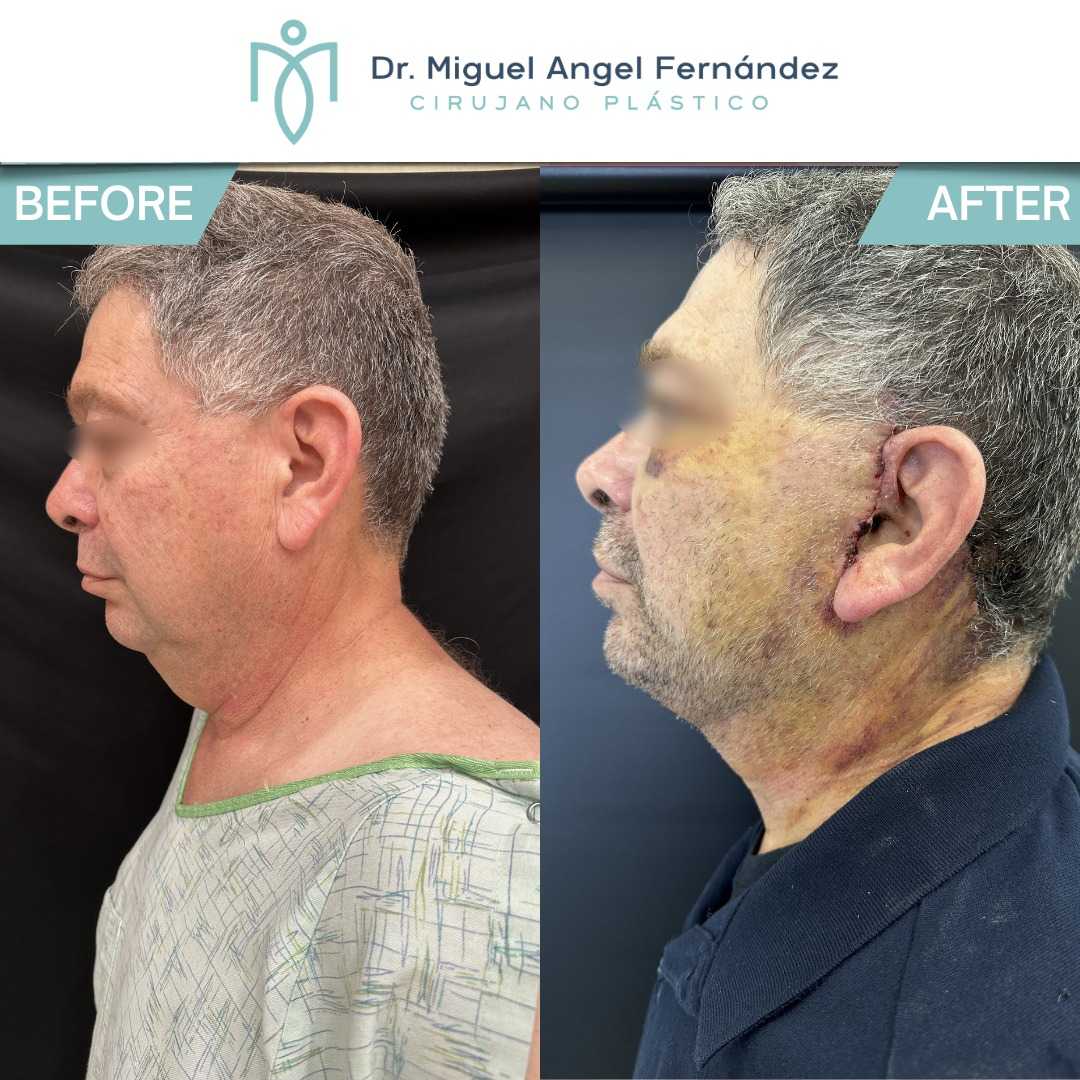 Antes y Después - Dr. Miguel Angel Fernandez - Lifting Facial en Mexicali México