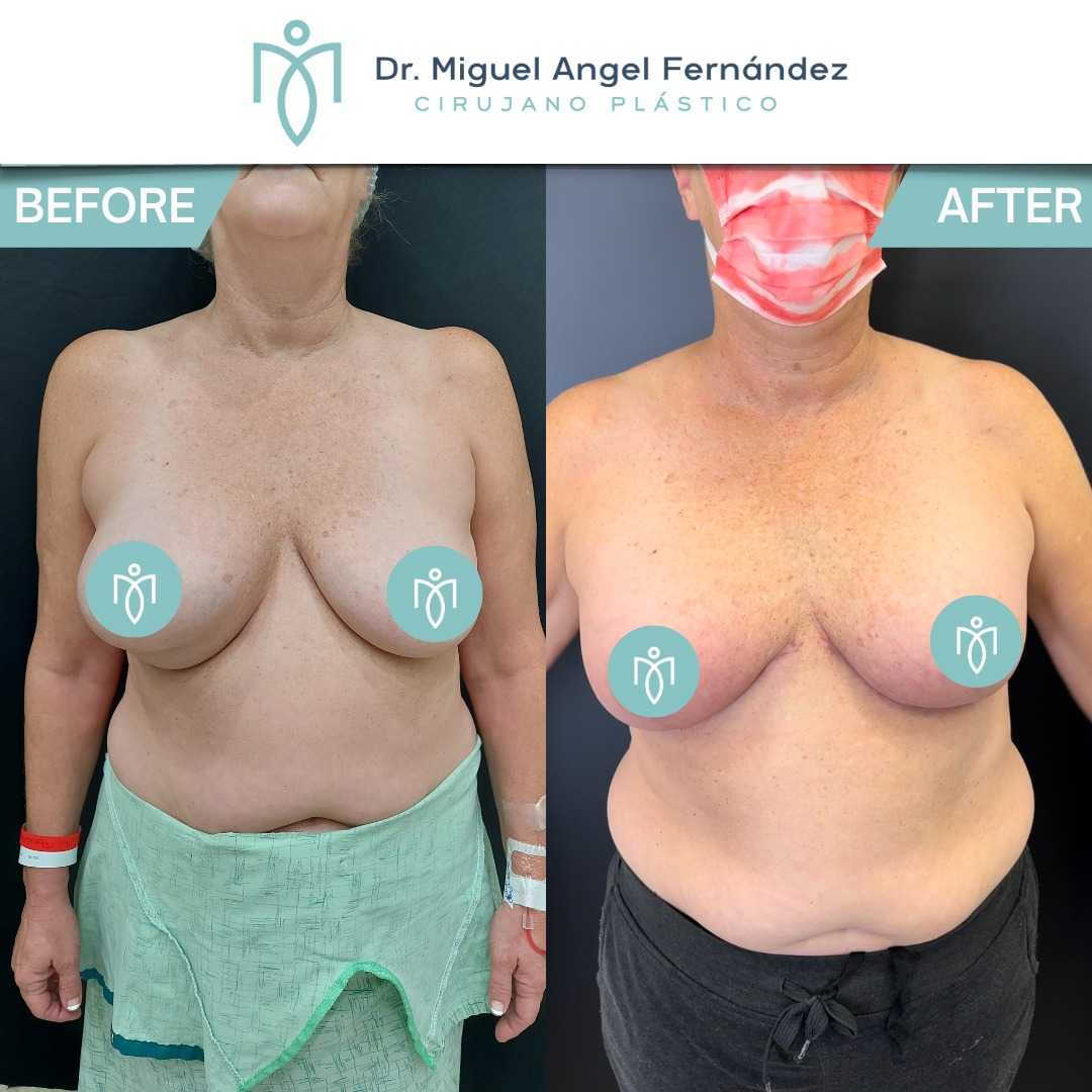 Antes y Después - Dr. Miguel Angel Fernandez - Mastopexia en Mexicali México
