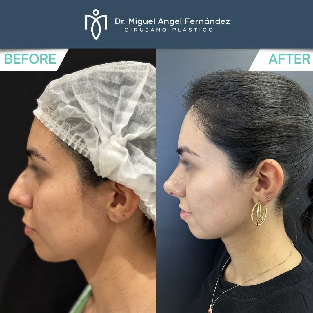Antes y Después - Dr. Miguel Angel Fernandez - Rinoplastia en Mexicali México