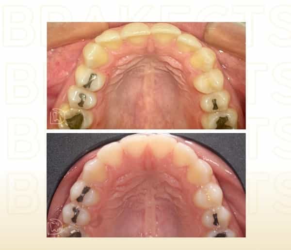 Imágenes de Antes y Después Tratamiento Dental Cancún