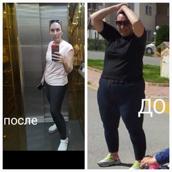 Antes y después de la cirugía bariátrica en Antalya, Turquía