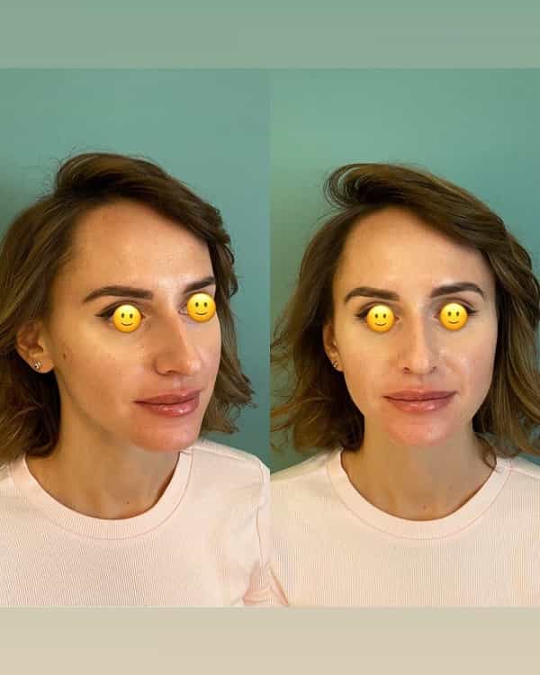 Antes y después de la cirugía de extracción de la almohadilla de grasa bucal en Antalya, Turquía