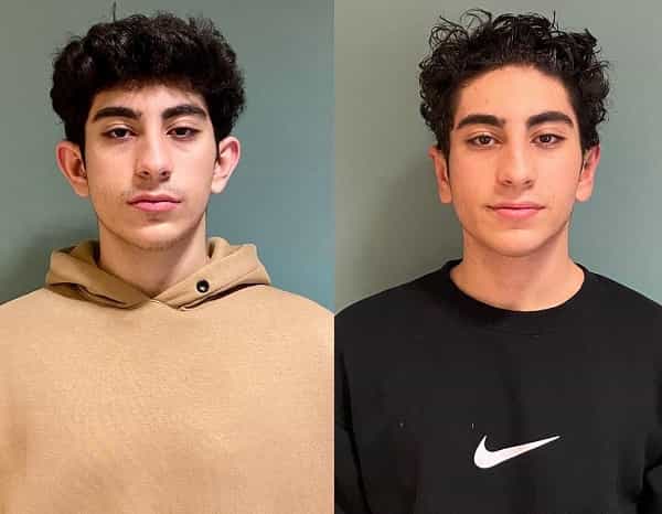 Antes y después de una cirugía de orejas en Antalya, Turquía