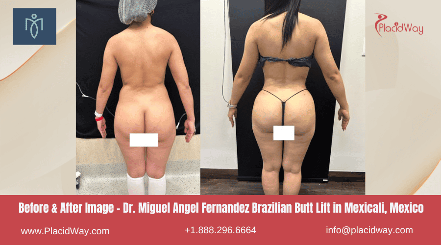 Imágenes de antes y después de la cirugía de liposucción en Mexicali, México, por el Dr. Miguel Ángel Fernández