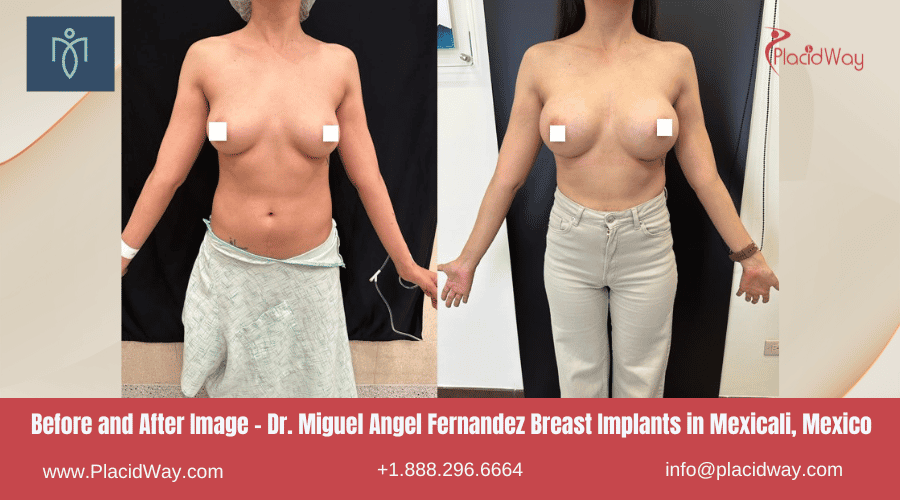 Imagen de antes y después - Implantes mamarios del Dr. Miguel Ángel Fernández en Mexicali, México