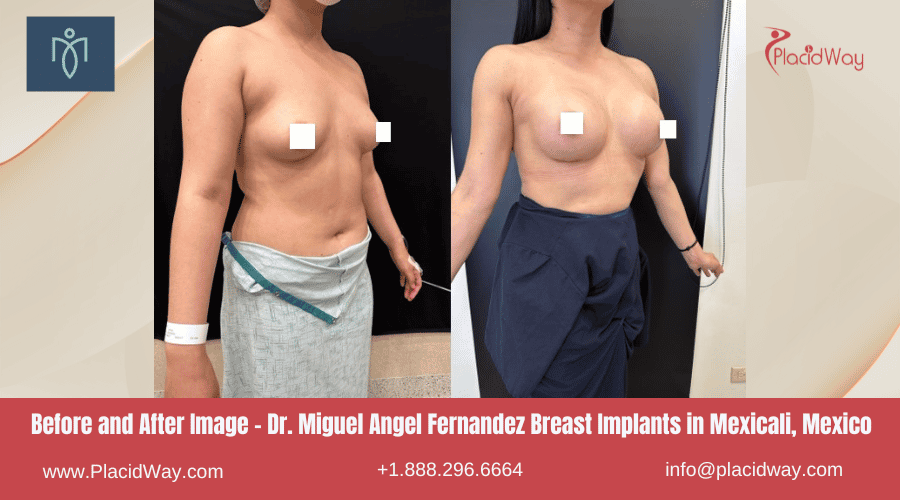 Implantes mamarios del Dr. Miguel Angel Fernández en Mexicali, México Imagen de antes y después