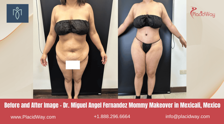Mommy Makeover en Mexicali, México por el Dr. Miguel Ángel Fernández Imágenes de antes y después