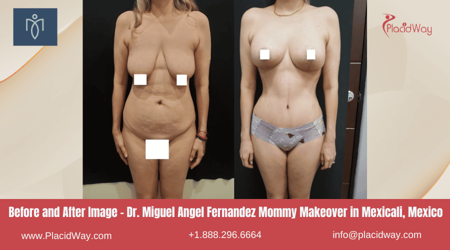 MMO en Mexicali, México por el Dr. Miguel Angel Fernández Imágenes de Antes y Después
