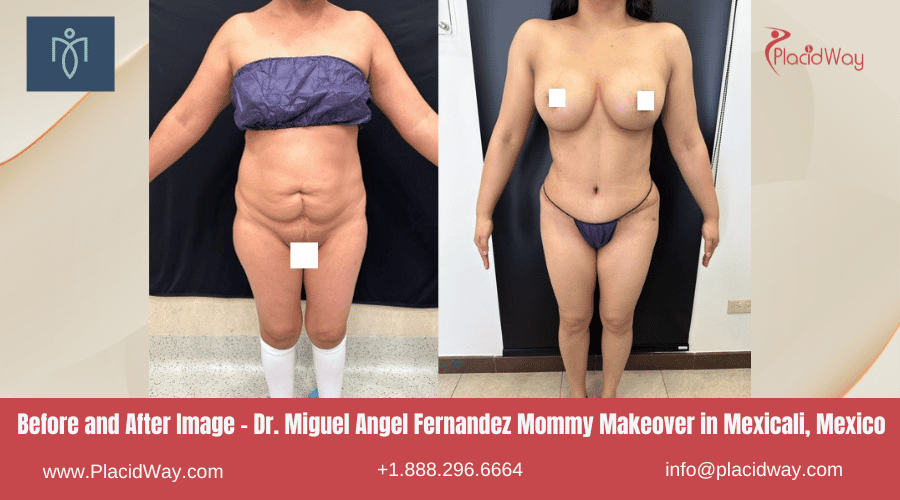 Imágenes de antes y después de Mommy Makeover en Mexicali, México, por el Dr. Miguel Ángel Fernández