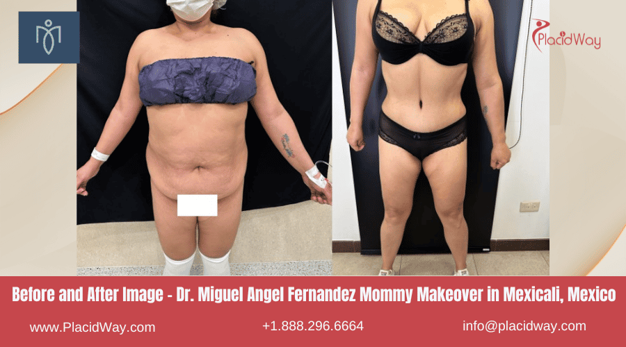 Imágenes de antes y después de MMO en Mexicali, México por el Dr. Miguel Ángel Fernández