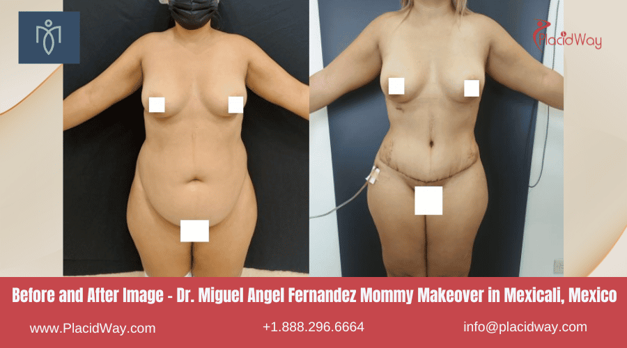 Imagen de antes y después del Dr. Miguel Angel Fernández Mommy Makeover en Mexicali, México