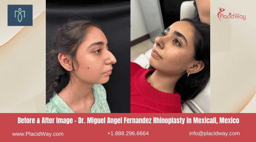 Rinoplastia en Mexicali, México por el Dr. Miguel Angel Fernández Imagen de Antes y Después