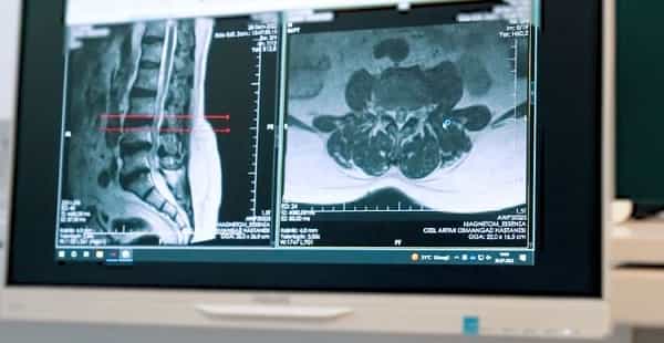 Хирургия позвоночника Ричарда Кимбира в Бурсе, Турция