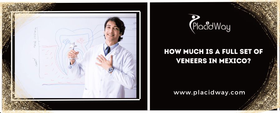 How Much is a Full Set of Veneers in Mexico? How Much is a Full Set of Veneers in Mexico?