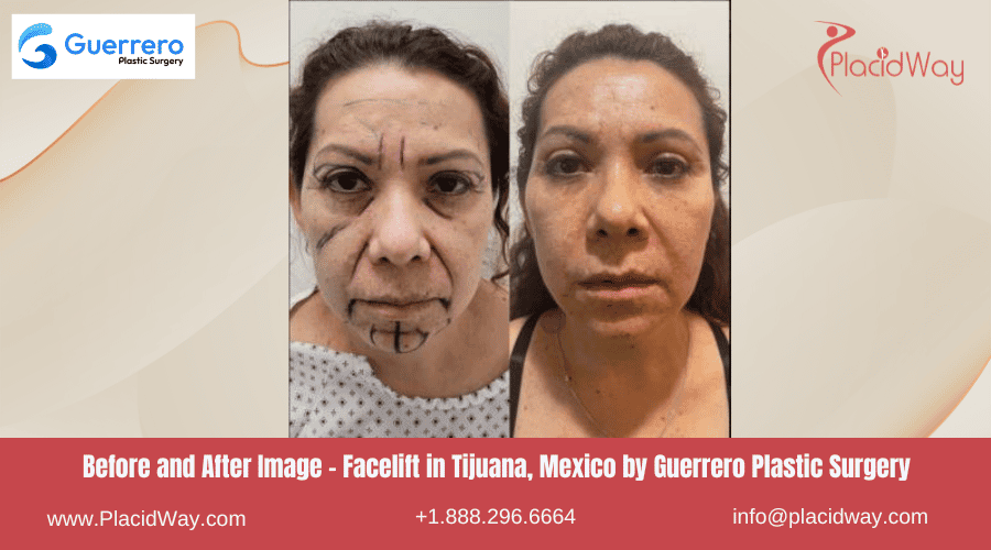 Facelift in Tijuana Mexico - Guerrero Plastic Surgery
