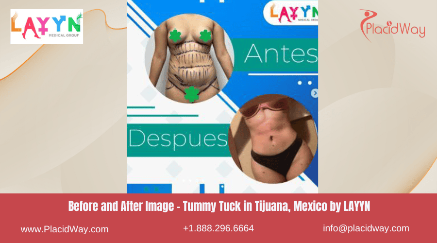 Tummy Tuck in Tijuana Mexico - LAYYN Clinic