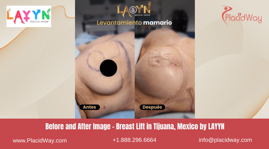 Breast Lift in Tijuana Mexico by LAYYN Medical Group