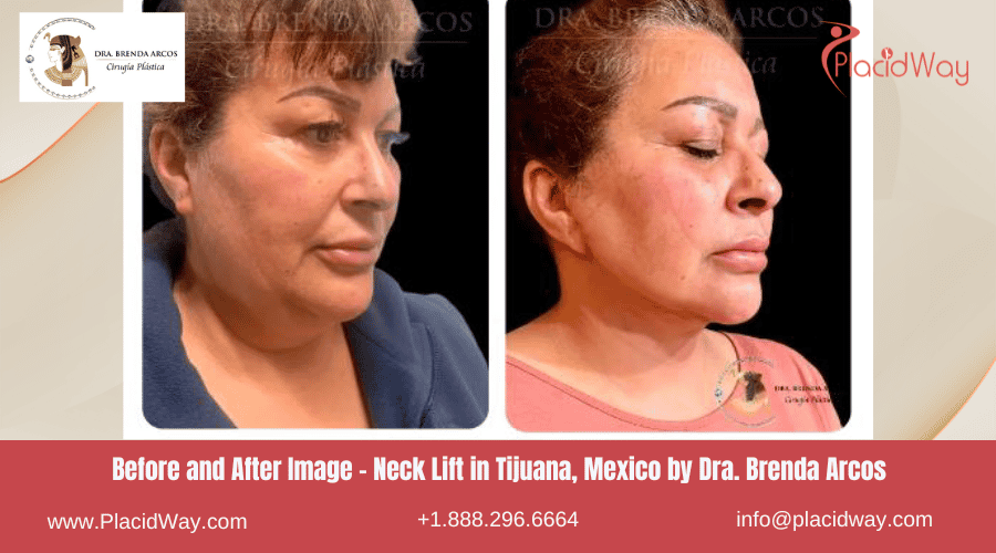 Lifting de Cuello en Tijuana México - Dra Brenda Arcos