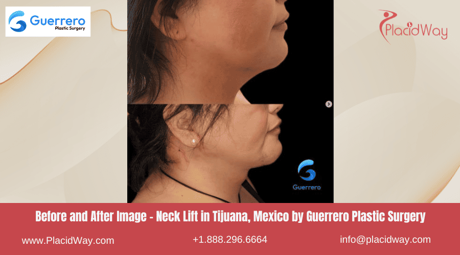 Lifting de Cuello en Tijuana México - Centro de Cirugía Plástica Guerrero